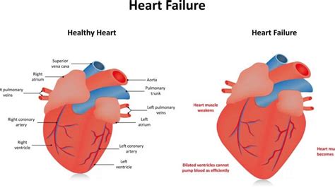 hypokinetic lv|severe hypokinesis of the apex.